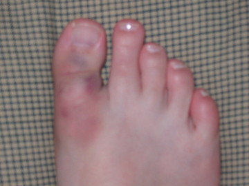 [bruised+foot.jpg]