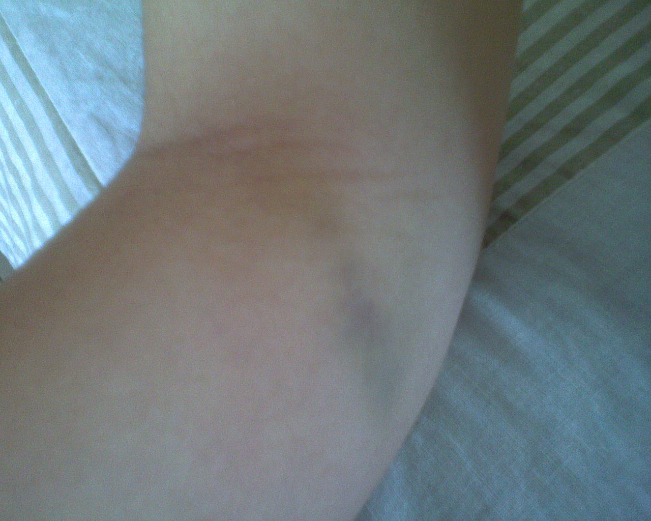 [bruised.JPG]