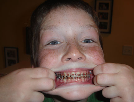 [Pat+with+braces+for+blog.jpg]