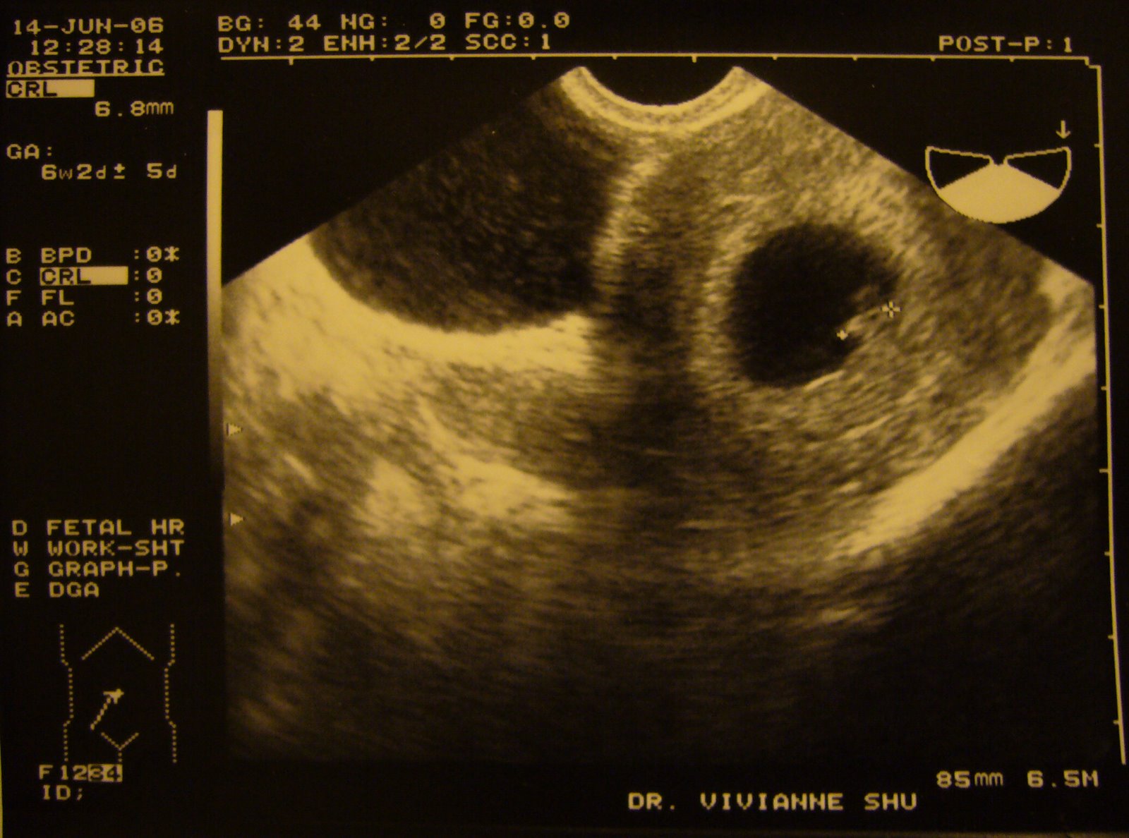 [first+ultrasound+pic.jpg]