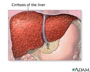 [liver-cirrhosis.jpg]
