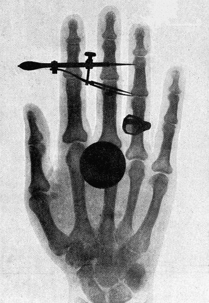 [Wilhelm-Roentgen's-X-ray-photograph-of-his-wife's-hand.png]