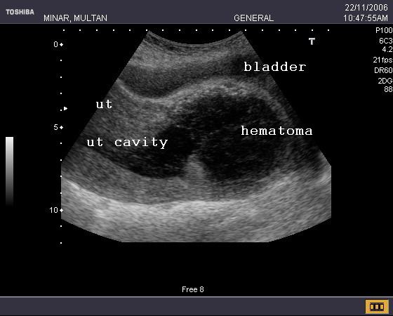 [ultrasound+gallery-+rupture+ut2.jpg]