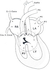 Defectos del tabique ventricular