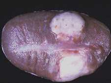 Tumor de células de Sertoli