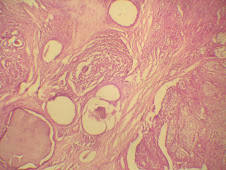 Adenocarcinoma complejo mamario