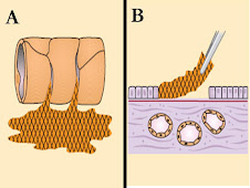 Exudado fibrinoso(A) y seudomembranas(B)