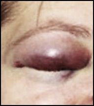 [bruised+eye3b.jpg]