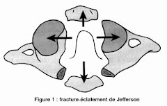 Sketch of a Jefferson Fracture