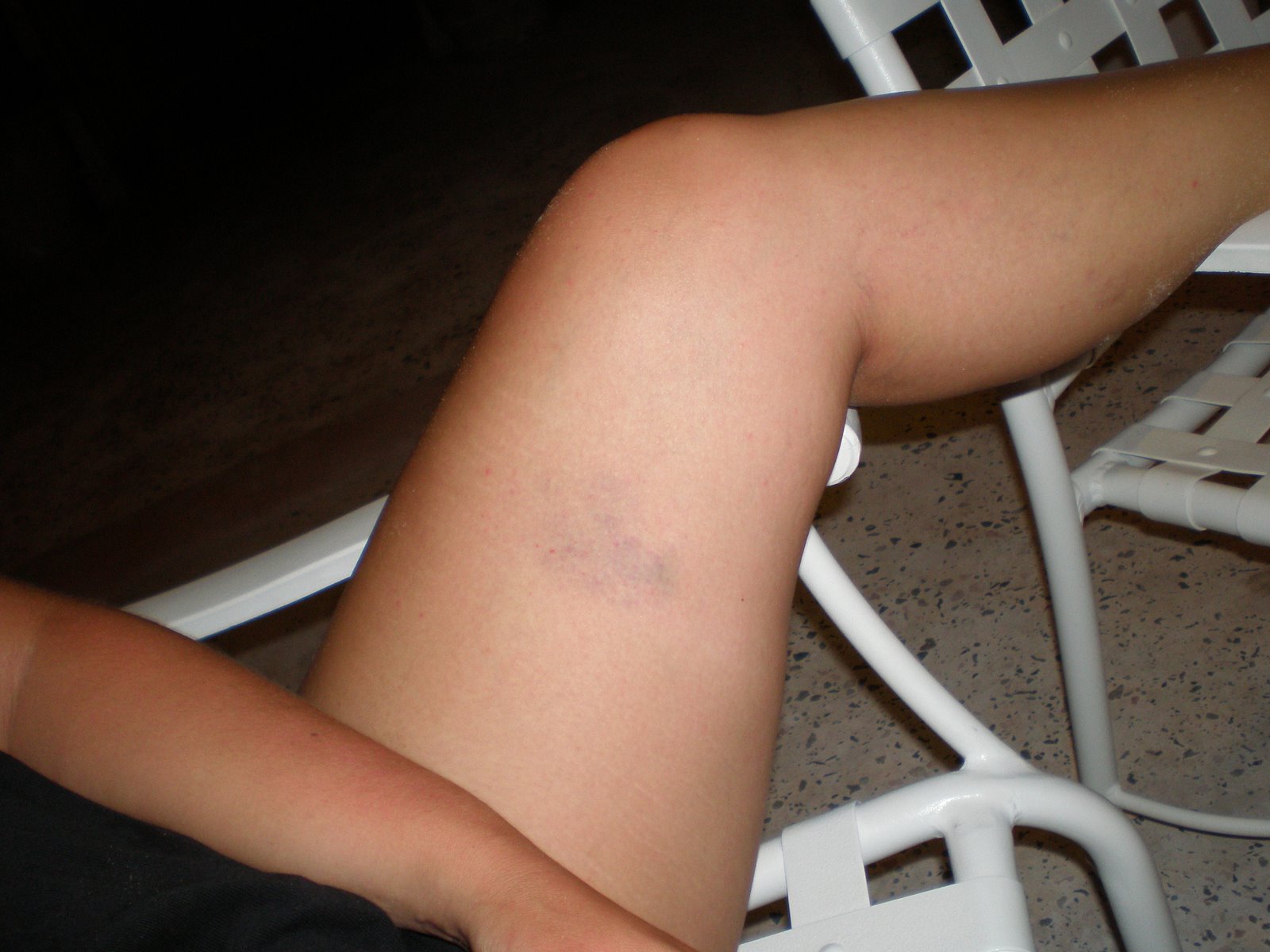 [ang+inner+thigh+bruise.JPG]