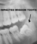 [wisdom+teeth.jpg]