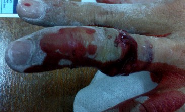 [finger+fracture+tendon+rupture.jpg]