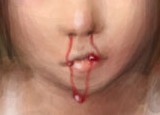[Nose+Bleed.jpg]