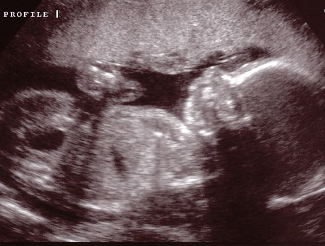 [Ultrasound+Images+6-15-2007+002.jpg]