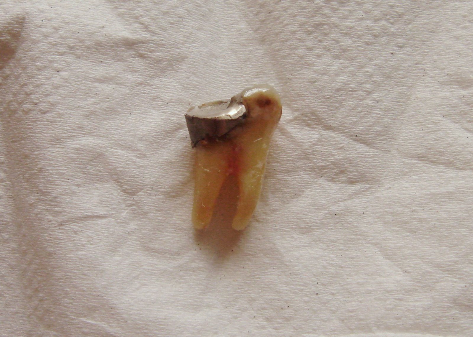 [Tooth+Extracted+on+8-Dec-07+(1).JPG]