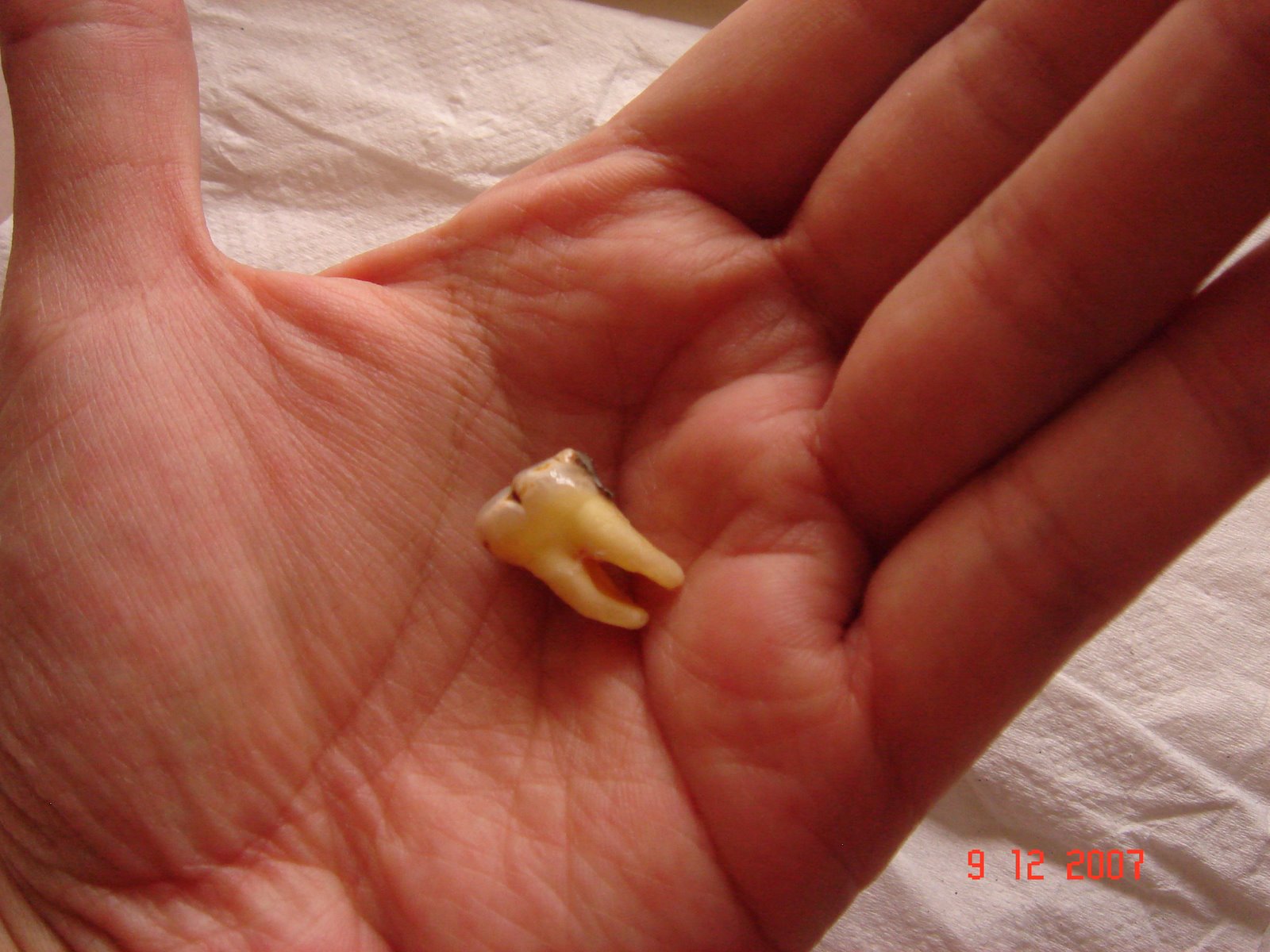 [Tooth+Extracted+on+8-Dec-07+(11).JPG]