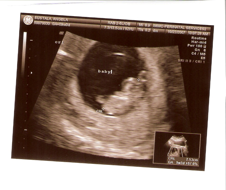 [ultrasound+baby+4.jpg]