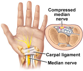 [carpal-tunnel-syndrome.jpg]