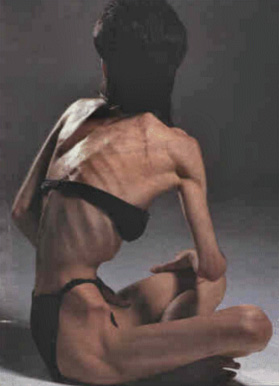 [anorexia+4.jpg]