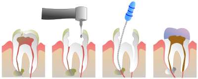 [400px-Root_Canal_Illustration_Molar.svg.png]