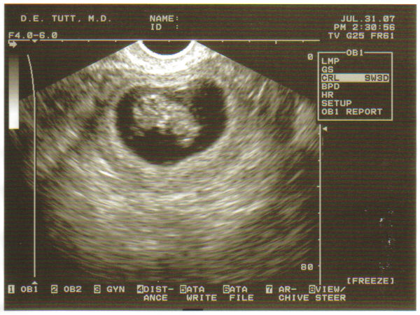 [Baby's+First+Picture+at+9w3d.jpg]