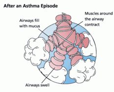 [470px-Asthma_before-after.jpg]