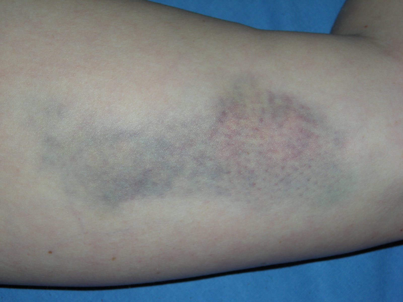 [bruise+day+two+004.jpg]