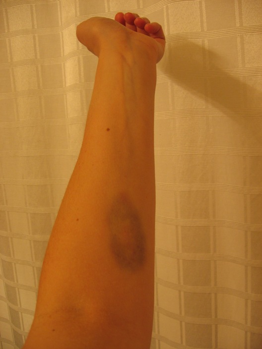 [bruise+on+arm.JPG]