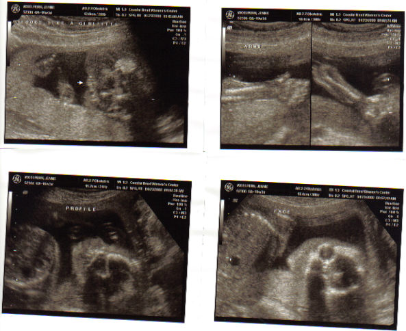 [ultrasound+19+weeks.jpg]