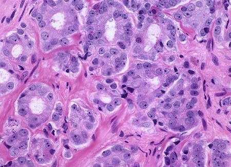 [Prostate AdenoCa4 - Gleason 3.jpg]