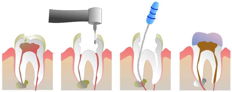 [800px-Root_Canal_Illustration_Molar.svg.png]