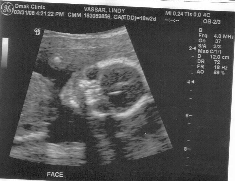[3-08+ultrasound+IV.jpg]