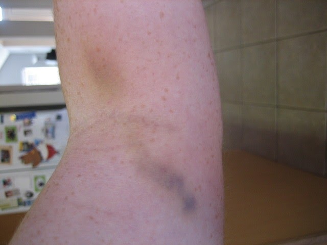 [my+bruise+erg.jpg]
