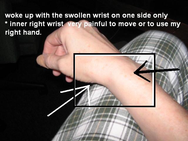 [2007_04_05_my+wrist+is+swollen.JPG]