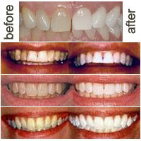 Portland teeth whitening testimonial