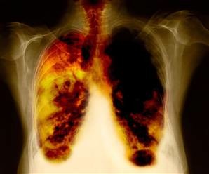 [pulmones+y+cancer.jpg]