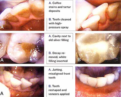 before-and-after-PHOTOS-OF-cosmetic-dentistry
