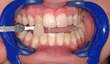 [cosmetic+surgery+san+francisco+tooth+whitening.bmp]