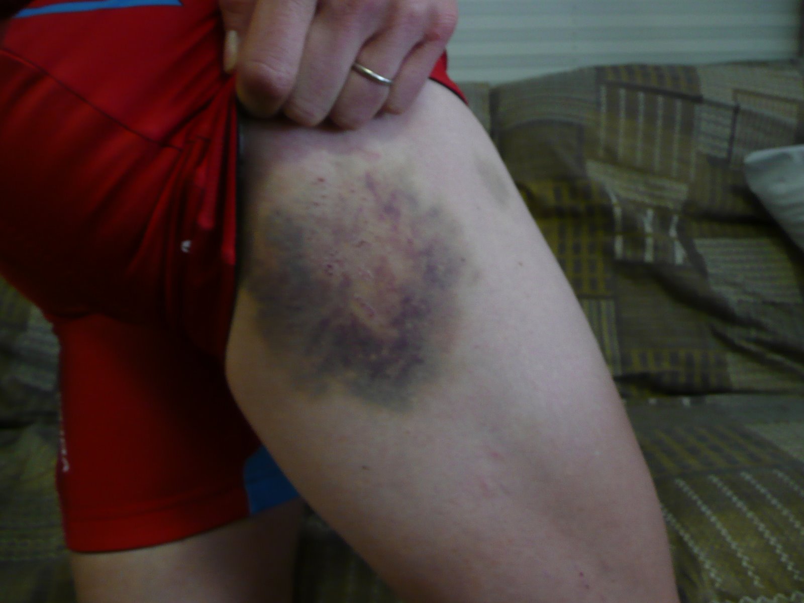 [Bruise+Hip.JPG]