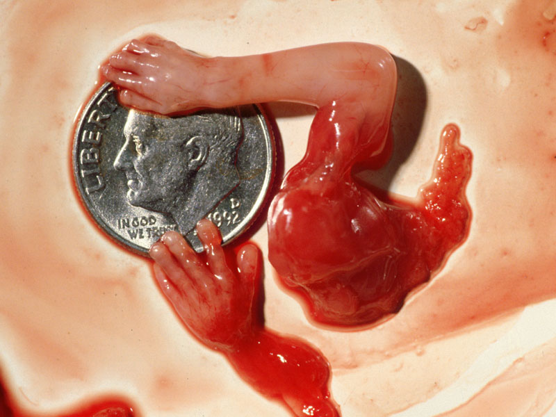 [Aborted+Fetus+at+10wks..jpg]