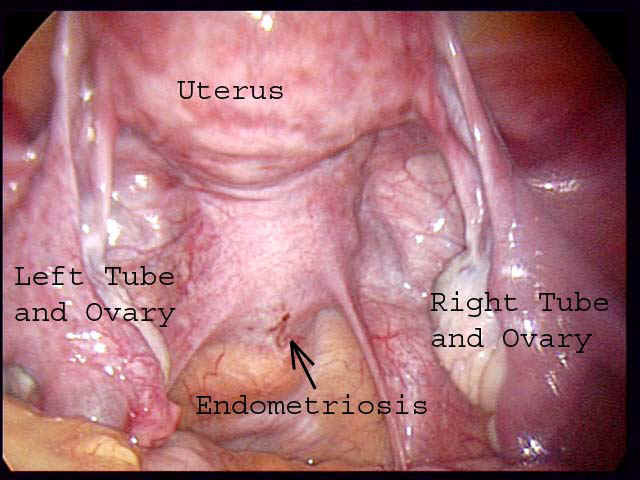 [endometriosis1.jpg]