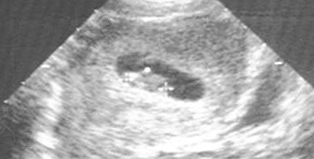 [Baby3_ultrasound_12-10.jpg]