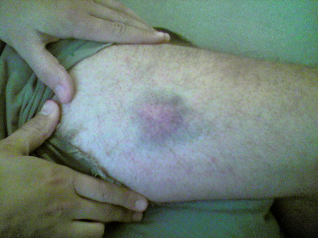 [bruise.jpg]