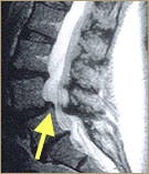 [spinal+stenosis2.jpg]
