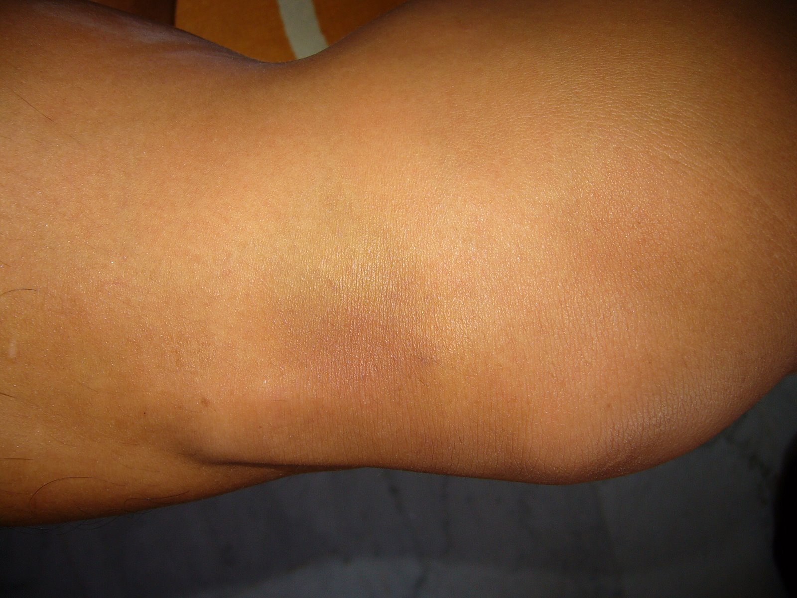 [left+knee+bruised.JPG]