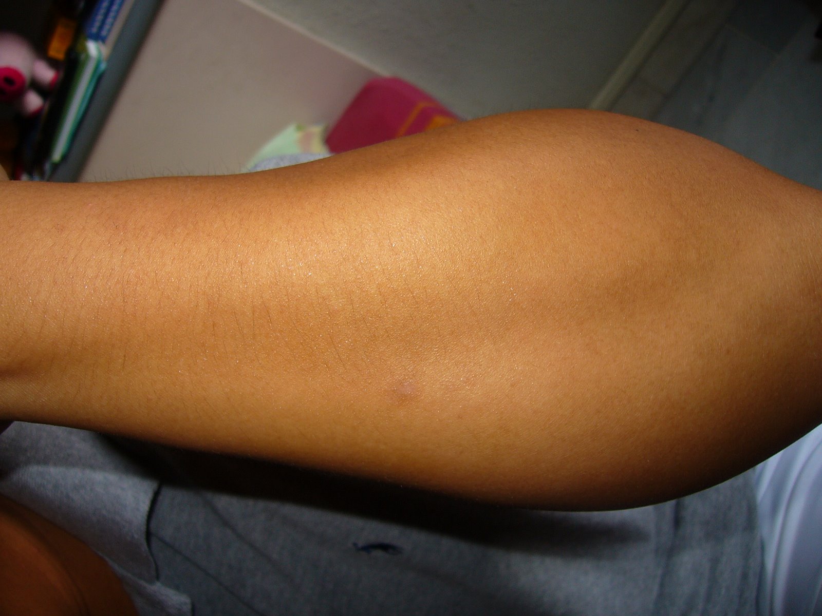 [left+forearm+bruised.JPG]