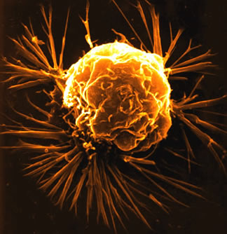 [breast-cancer-cell.jpg]