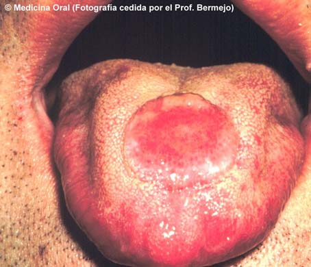 Sifilis en la lengua