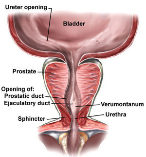 [transurethral-resection-of-the-prostate-surgery+TURP.jpg]