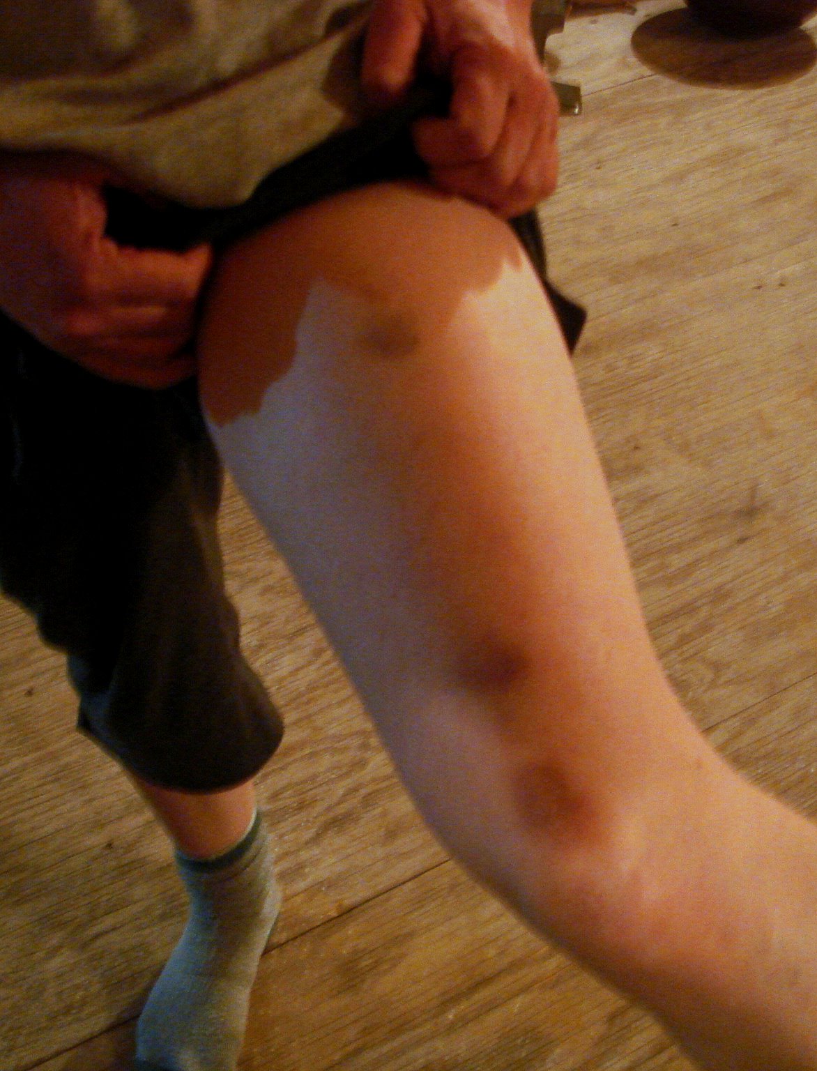 [bruise.jpg]